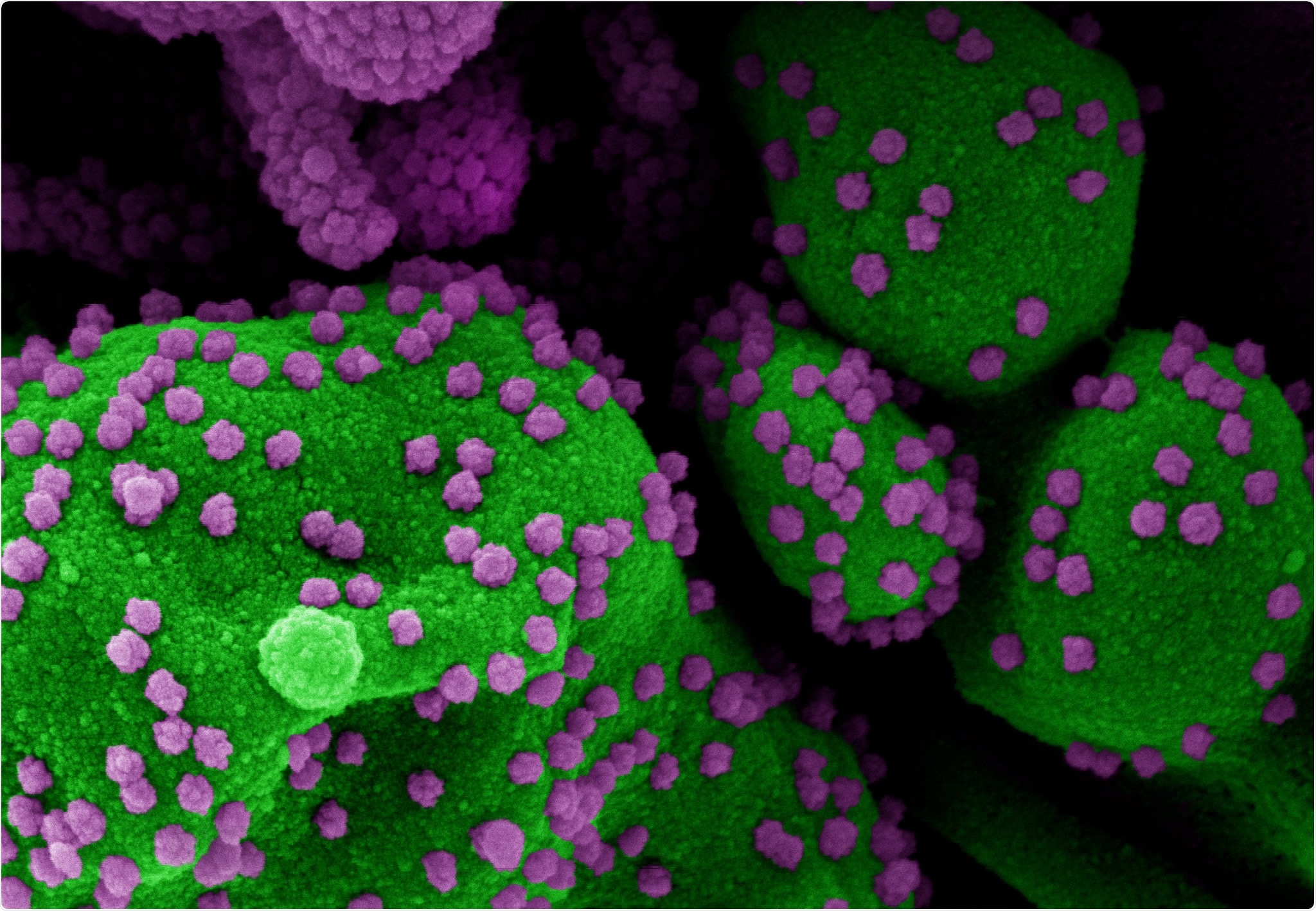 Colorized scanning electron micrograph of an apoptotic cell (green) heavily infected with SARS-CoV-2 virus particles (purple), isolated from a patient sample. Image at the NIAID Integrated Research Facility (IRF) in Fort Detrick, Maryland. Credit: NIAID