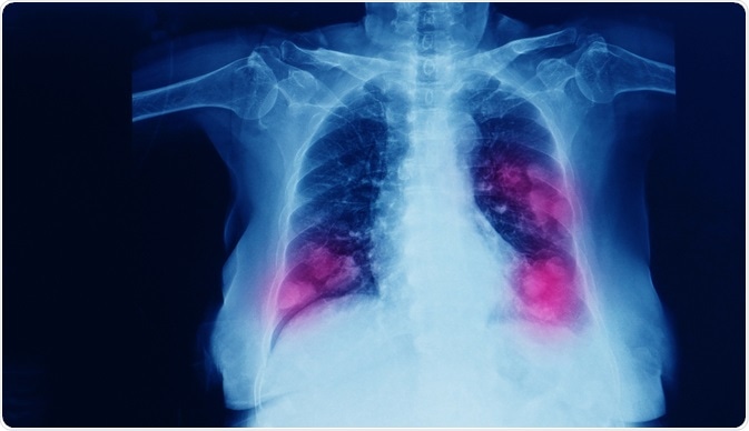 Metastatic cancer lung treatment