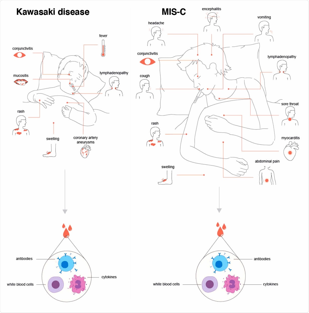 MIS-C has overlapping features with Kawasaki disease