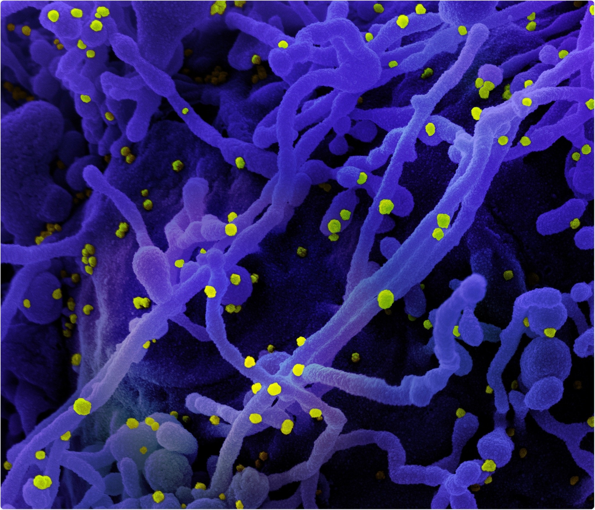 Colored scanning electron micrographs of cells infected with SARS-CoV-2 virus particles (yellow) (purple) isolated from patient samples. Image taken at the NIAID Integrated Research Facility (IRF) in Fort Detrick, Maryland. Credit: NIAID