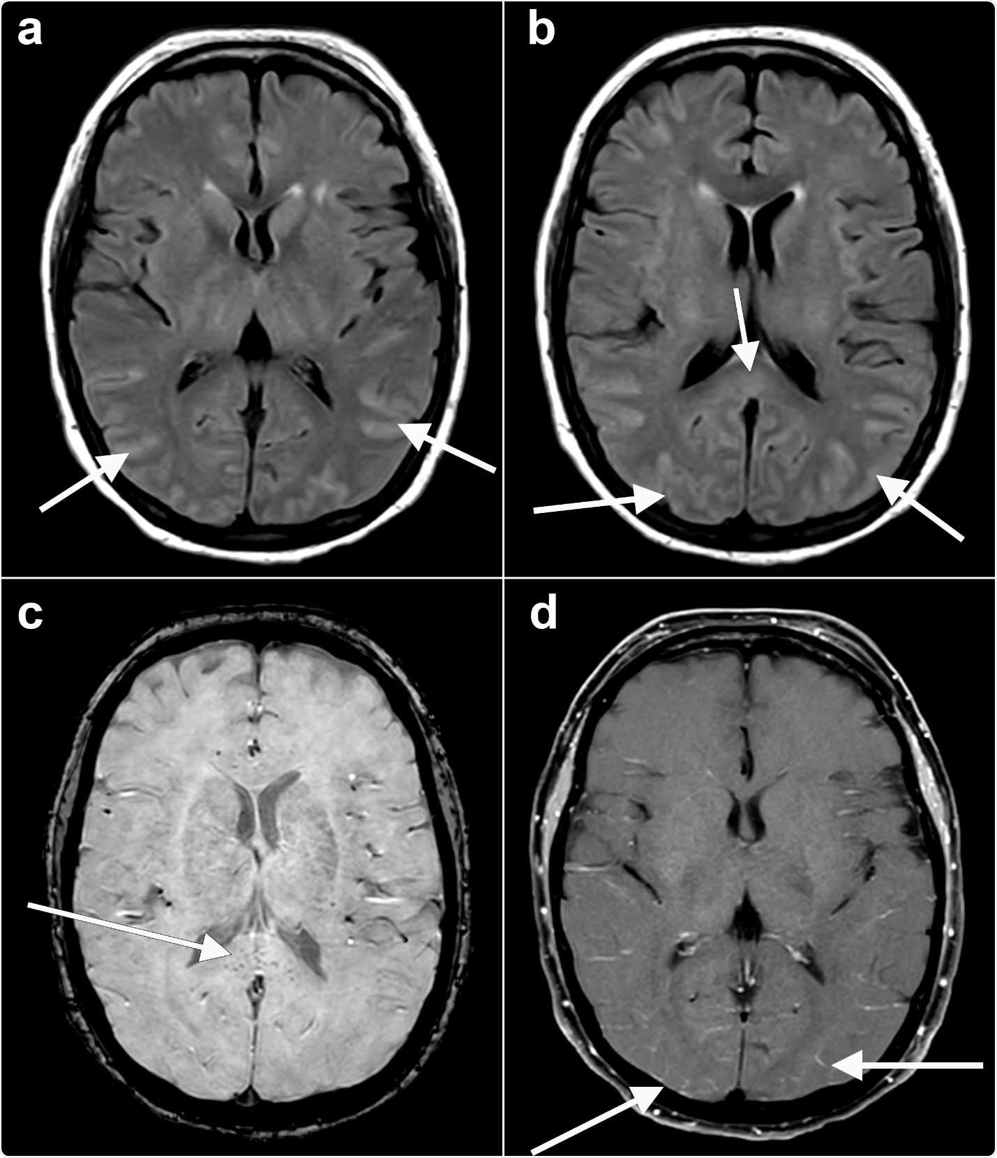 Axial fluid-attenuated inversion recovery (FLAIR) (a, b) images at the level of the basal ganglia show abnormal FLAIR hyperintense signal (arrows) affecting the bilateral occipital, temporal lobes. This appears almost sulcal suggesting a higher protein component within the cerebrospinal fluid. Note the elevated FLAIR signal in the splenium of the corpus callosum (arrow) suggesting parenchymal insult. Axial susceptibility weighted imaging (SWI) (c) at the level of the splenium of the corpus callosum shows small areas of susceptibility (arrow) in the splenium, likely related to microhemorrhage. Axial T1 (d) postcontrast with fat suppression at the level of the basal ganglia shows subtle, though true, enhancement (arrows) in the posterior sulci, arachnoid pial (leptomeningeal) pattern suggesting a degree of encephalitis.