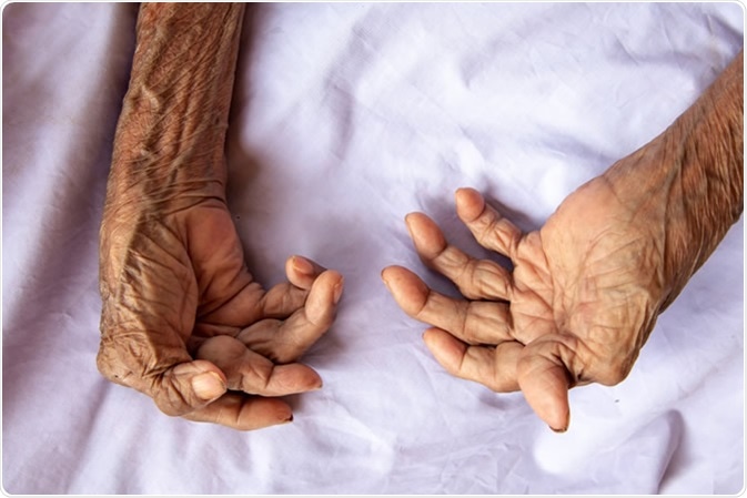 The hands of a woman with rheumatoid arthritis. Image Credit: Witsawat. S / Shutterstock