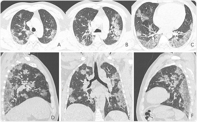 Images in a 44-year-old man who presented with fever and suspected COVID-19 pneumonia. A-C, Thin-slice (1-mm) axial CT images showed multiple patchy ground-glass opacity along the peribronchial and subpleural lungs. Some reticular opacities were also found within areas of ground glass (crazy-paving pattern). Lymphadenopathy was absent. D-F, Multiplanar reconstruction showed diffuse distribution of lesions.