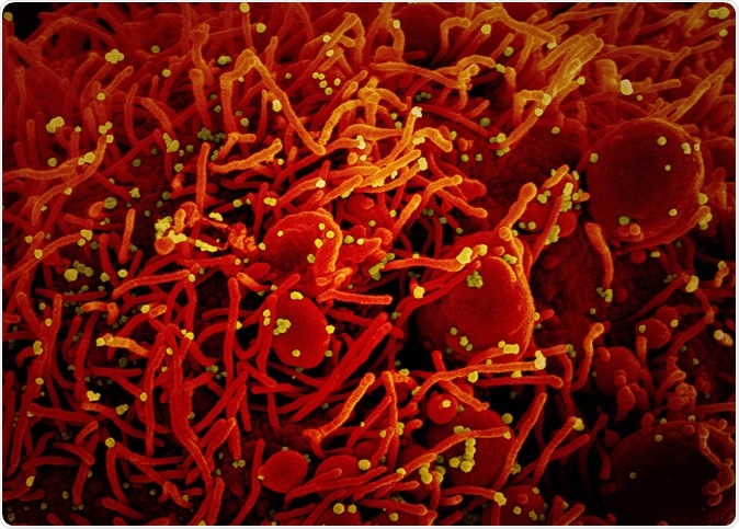 Colorized scanning electron micrograph of an apoptotic cell (red) infected with SARS-COV-2 virus particles (yellow), isolated from a patient sample. Image captured at the NIAID Integrated Research Facility (IRF) in Fort Detrick, Maryland. Credit: NIAID