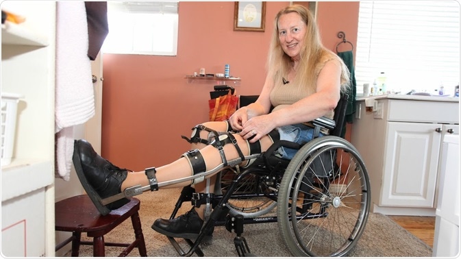 Body Integrity Dysphoria