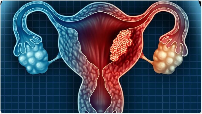 Newly discovered endometrial cancer biomarker enables early detection and treatment Newly discovered endometrial cancer biomarker enables early detection and treatment