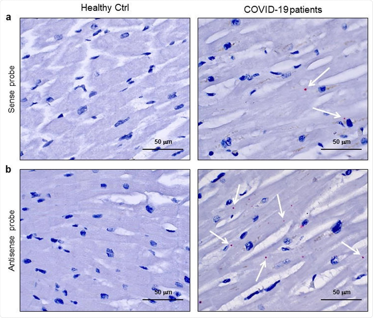 SARS-CoV-2 sense and antisense RNAs are localized in cardiomyocytes of COVID-19 patients.  ab) Representative of spatially resolved viral RNA detection by RNAScope assay on 3 μm slides of formalin-fixed paraffin-embedded left ventricle specimens from healthy controls (Healthy Ctrl, left panel) and COVID-19 patients (COVID-19, middle and right panels). Image for SARS-CoV-2 sense (a) and antisense (b) probes for spike protein RNA sequencing.  Fast Red dots indicate the presence of viral RNA (white arrow).  Nuclei are counterstained with hematoxylin.  Magnification as a scale bar.