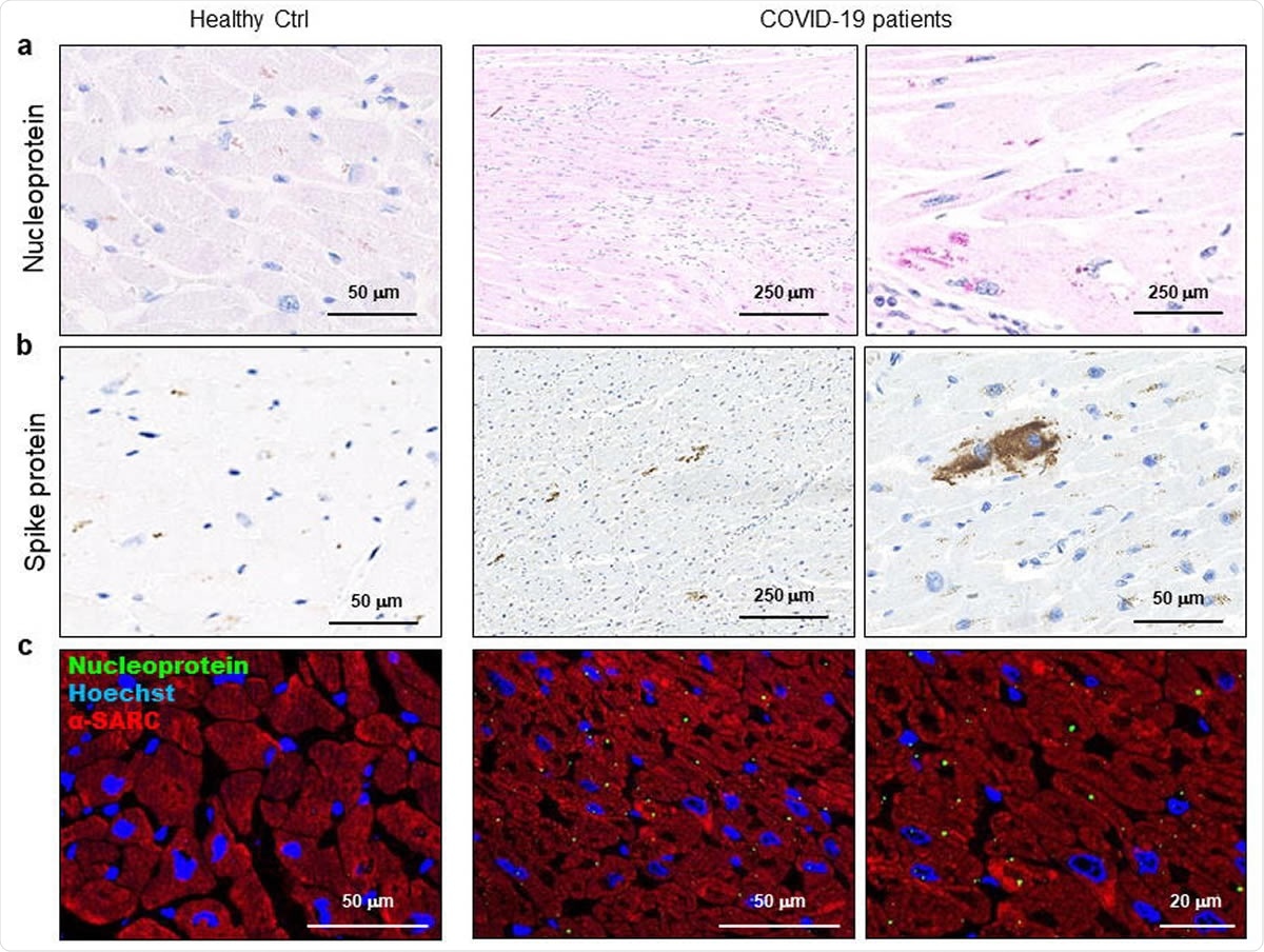 SARS-CoV-2 protein can be detected in cardiomyocytes of COVID-19 patients.  ab) Representative of immunohistochemical assay of 3 μm slides of formalin-fixed paraffin-embedded left ventricle specimens from healthy controls (Healthy Ctrl, left panel) and COVID-19 patients (COVID-19, middle and right panels) for SARS-CoV. Image-2 nuclear protein (a, red) and spike protein (b, brown).  c) Representative of a 3 μm slide immunofluorescence assay of formalin-fixed paraffin-embedded left ventricular specimens from healthy controls (Healthy Ctrl, left panel) and COVID-19 patients (COVID-19, middle and right panels) for SARS-CoV. Image-2 nuclear protein (green) and sarcomeric α-actin (α-SARC, red).  Nuclei are stained with Hoechst (blue).  Magnification as a scale bar.