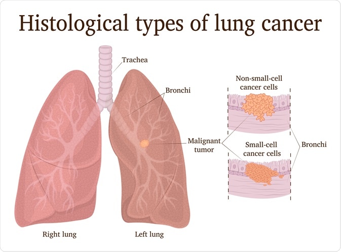 Types Of Lung Cancer Tumors