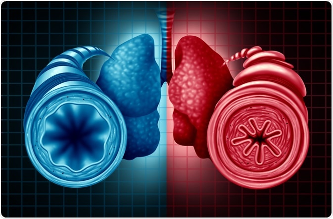 a diabetes asthma bronchiale)