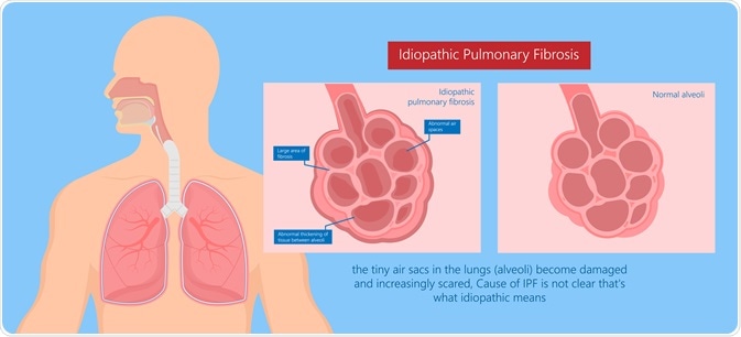 Lung fibrosis