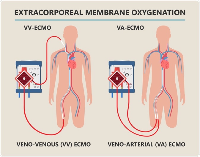 Infections of Extracorporeal membrane oxygenation