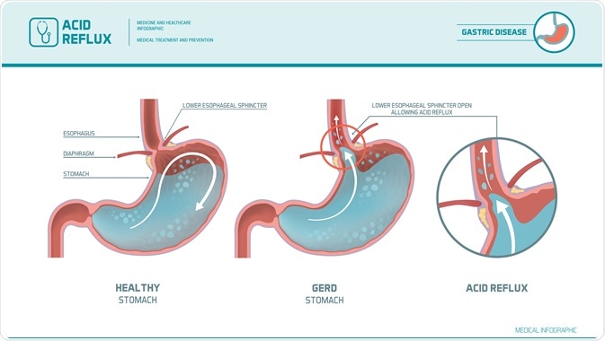 Heartburn symptom