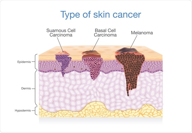  The Future of Skin Cancer Detection