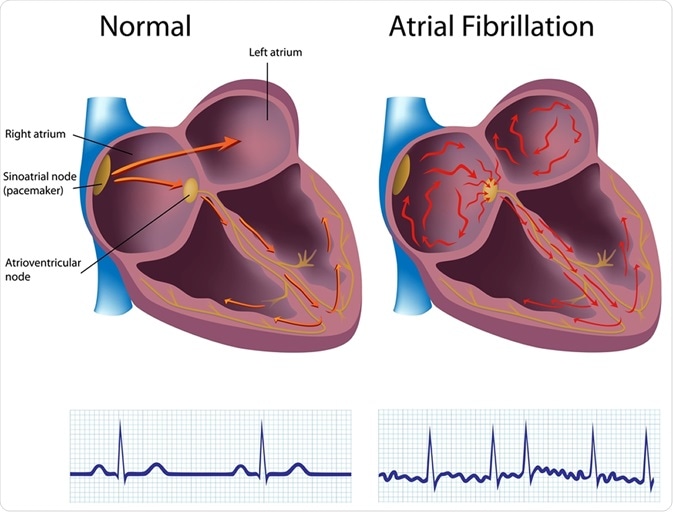 atrial fibrillation)