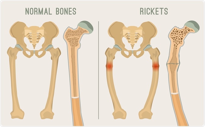 What is Rickets?
