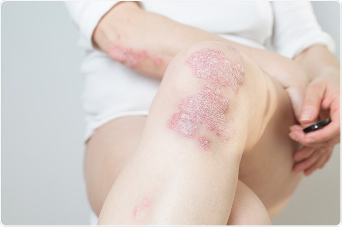 psoriasis cdc