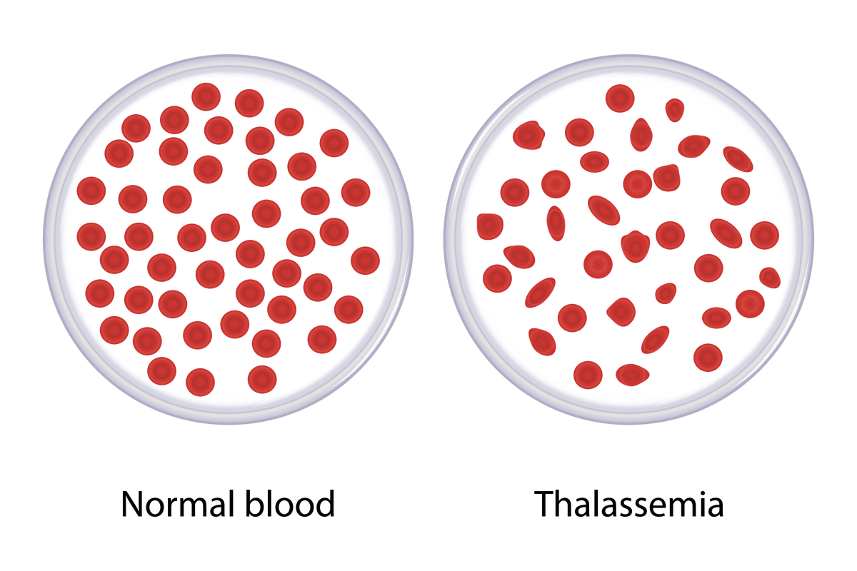 Can thalassemia take covid vaccine