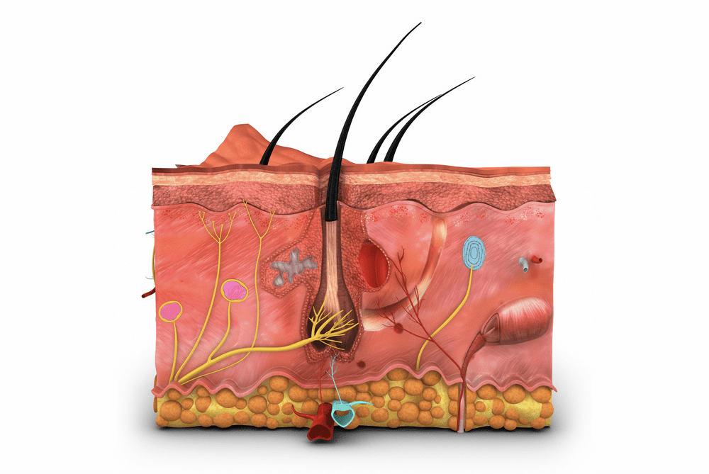 confluent and reticulated papillomatosis svenska