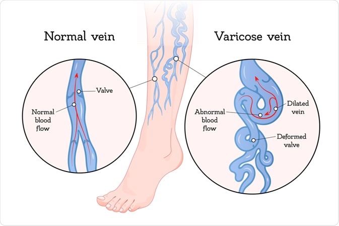 cysta varicose varicoza moarte