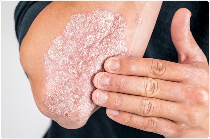 psoriasis painful joints