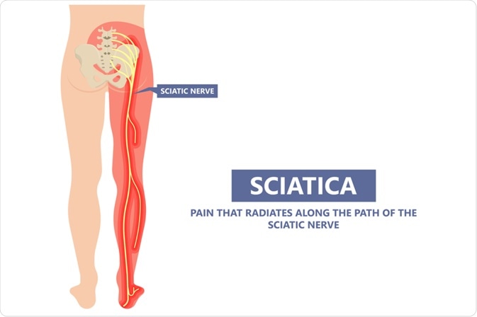 Sciatica: Causes, Symptoms, Treatment, Prevention & Pain Relief