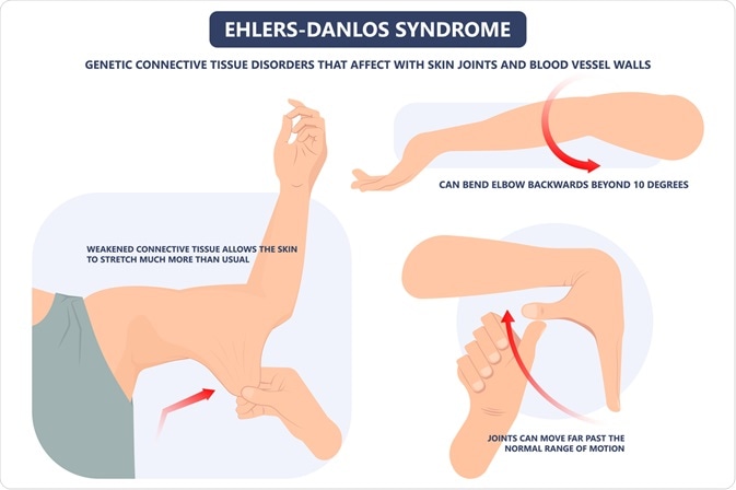 Hypermobile Ehlers-Danlos Syndrome and Hypermobility Spectrum Disorders -  American Family Physician
