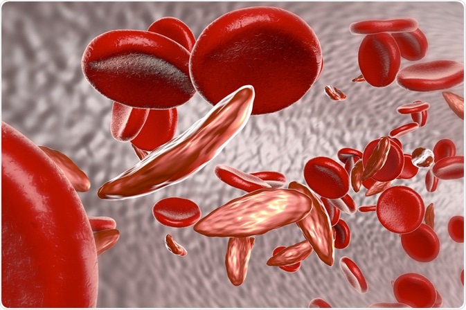 sickle cell anemia research paper outline