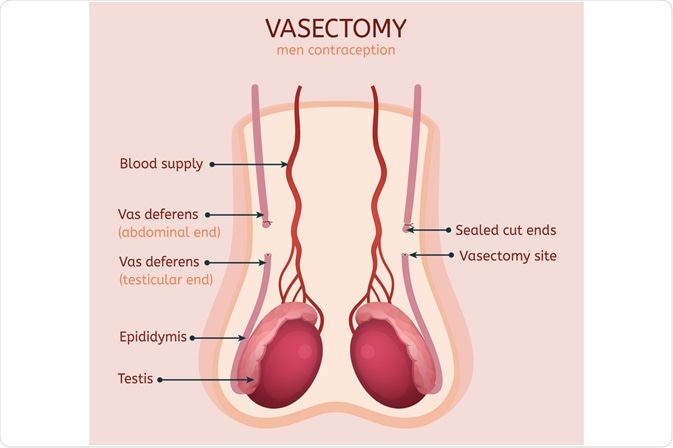 What is a Vasectomy?