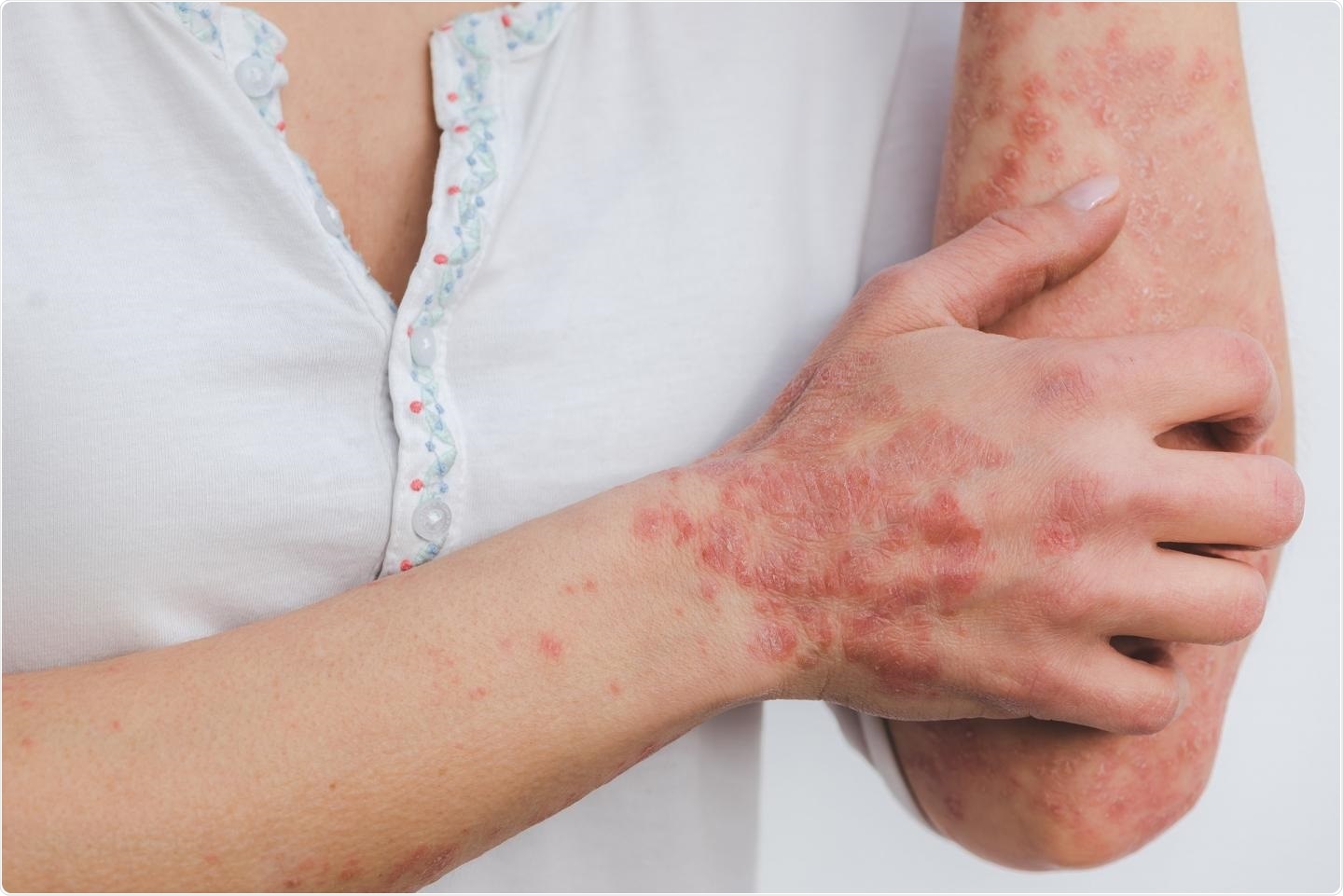 is psoriasis an autoimmune disease covid