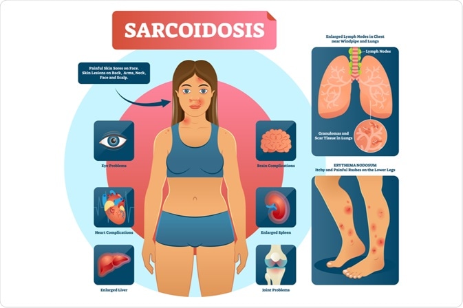 Sarcoidosis Symptoms