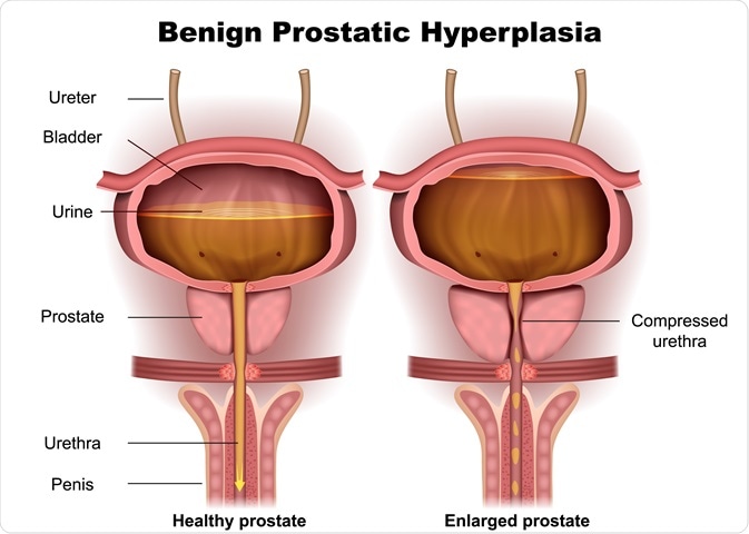 prostate 1 hyperplasia)