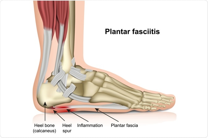 What is Plantar Fasciitis?