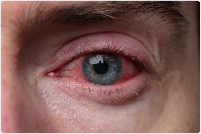 Blepharitis Treatment