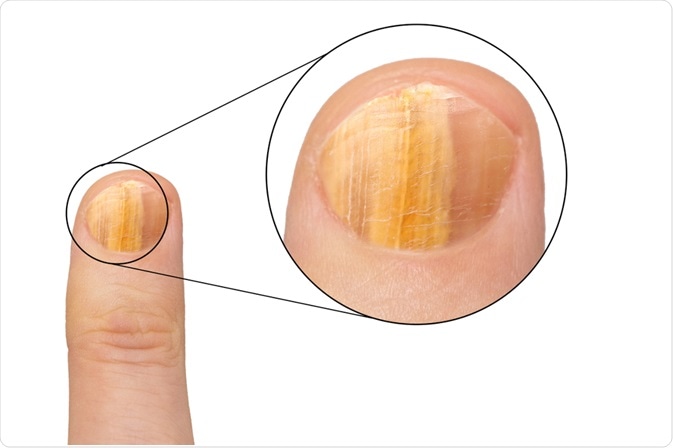 Before and after Successful Treatment for a Onychomycosis or Fungal Nail  Infection on Damaged Nails after Gel Polish Stock Photo - Image of disease,  medical: 216597144