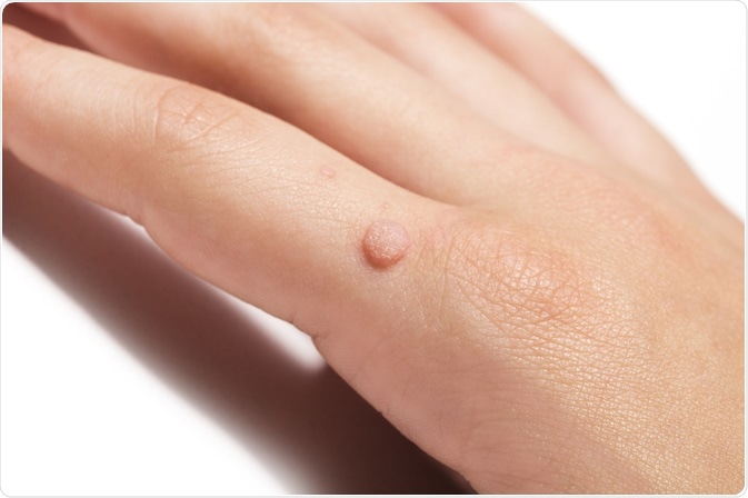 warts and ovarian cancer