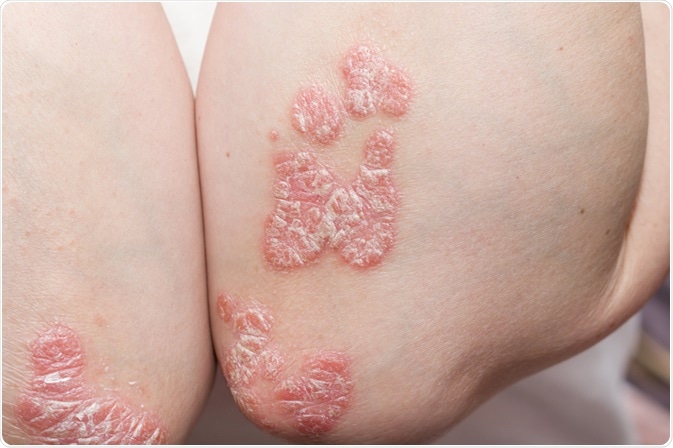 What is Psoriasis?