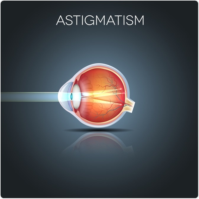 Astigmatism hipermetropic