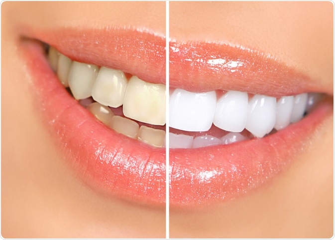 What is Teeth Whitening?