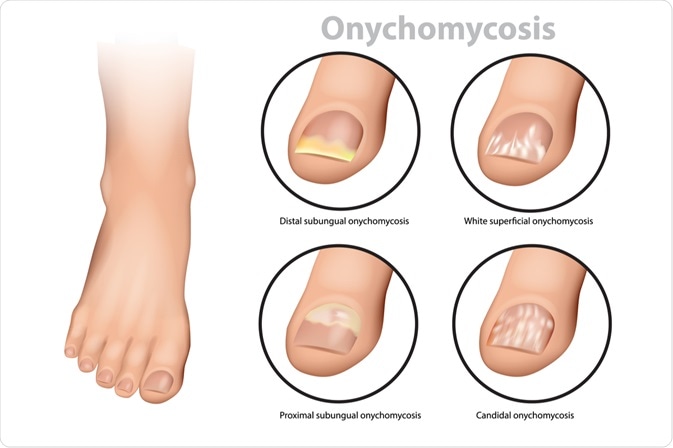 proximal subungual onychomycosis symptoms