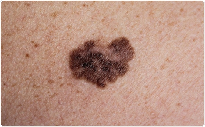 A melanoma look what like does Melanoma