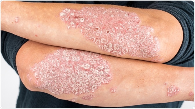 does psoriasis spread