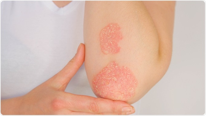 psoriasis differential diagnosis pdf)