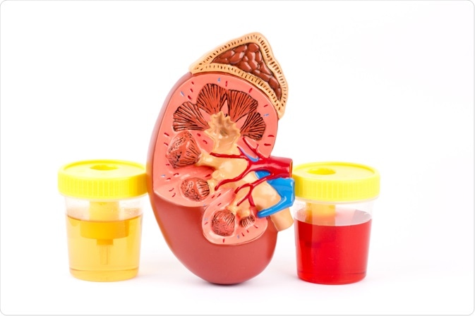 Hematuria