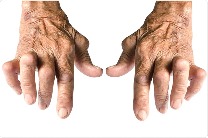 rheumatoid arthritis 20 évesen égő fájdalom a térd oldalán