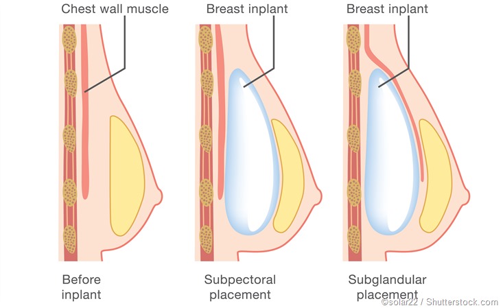 5 Easy Facts About Breast Reconstruction Shown thumbnail