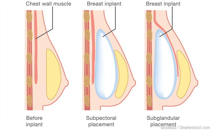 Hip Surgery Risks thumbnail