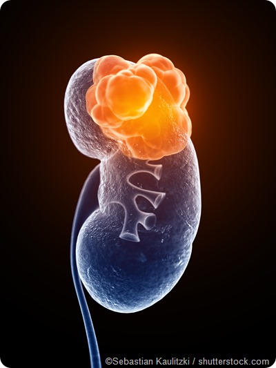 Illustration of kidney cancer