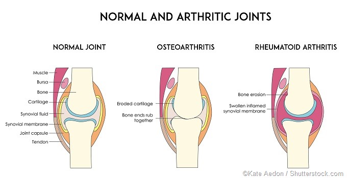 Osteoarthritis Rheumatoid Arthritis illustration