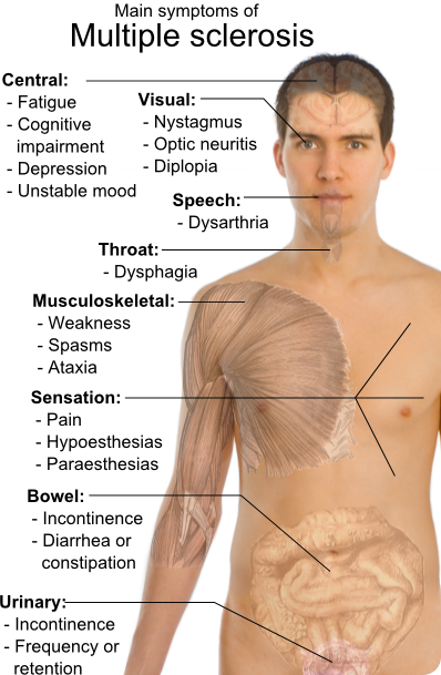 Multiple sclerosis